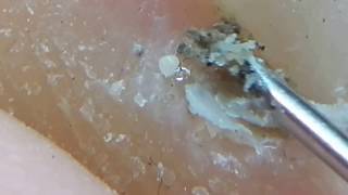 How to clean in depth lateral toenail fold 7 After beach [upl. by Schlessinger395]