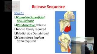 Correction of Varus def in TKR [upl. by Hesler]