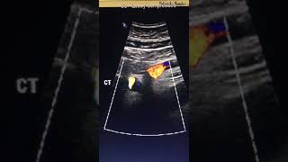 Ultrasound of Abdominal Aorta [upl. by Megen]