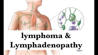 lymphoma amp lymphadenopathy pathology Hematologyamp Oncology Integrated lecture by ASM Minds Team [upl. by Hamrnand]