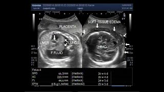 Ultrasound Video showing Hydrops fetalis Soft tissue edeme and Fetal pleural effusion [upl. by Notsnarc]