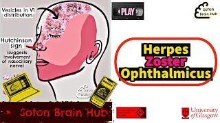 Herpes Zoster Ophthalmicus [upl. by Kendra]