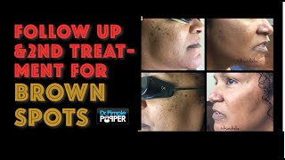 Laser treatment for brown spots part 2 [upl. by Canice]