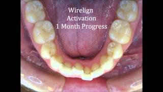 Wirelign® Orthodontics Invisible And Comfortable Way To Straighten Teeth [upl. by Anawt719]