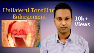 Unilateral Tonsillar Enlargement Aetiologies and Evaluation [upl. by Chemush968]