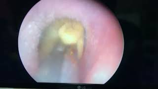 Ear wick removal in patient with otitis externa [upl. by Moraj]