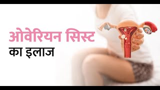 Benign Ovarian Cyst  बिनाइन ओवेरियन सिस्ट क्या होता है  Its Symptoms And Treatment [upl. by Onilegna]