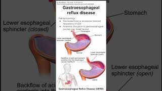 Gastroesophageal reflux disease GERD [upl. by Merchant]