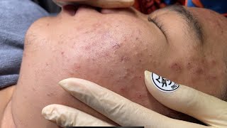 Blackheads amp Whiteheads Removal New 2024  Acne Treatment With Bo Nguyễn Spa 008 [upl. by Grannia]