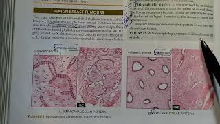 Fibroadenoma fully Explained Pathology ⚕️ [upl. by Dunkin]