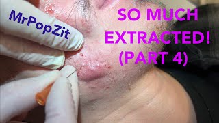 So much extracted Severe acne before and after Session 2 Comedones for days [upl. by Rednaskela]