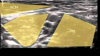 Ultrasound Guided Interscalene Nerve Block [upl. by Parris866]