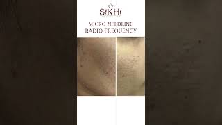 Micro Needle Treatment for Acne  Before amp After  Sikhi Skin Clinic Kondapur Hyderabad skincare [upl. by Davey126]