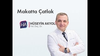 Makatta Çatlak Anal Fissür [upl. by Goldston]