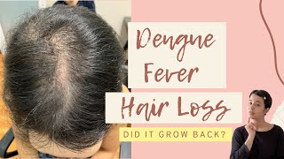 DENGUE FEVER HAIR LOSS  Telogen Effluvium  Female Hair Loss [upl. by Bajaj]