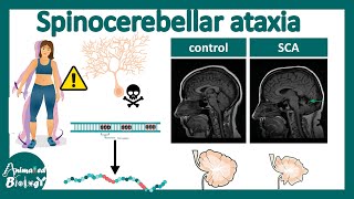 Spinocerebellar Ataxia  Pathology diagnosis and treatment of Spinocerebellar Ataxia  USMLE [upl. by Macur]