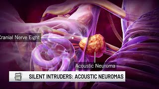 Medical Moment Acoustic neuroma treatment [upl. by Airtemad]