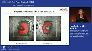 3 Pegcetacoplan therapy in geographic atrophy GA [upl. by Shara849]