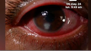 Reconoce las infecciones en los ojos causadas por hongos [upl. by Niraj410]