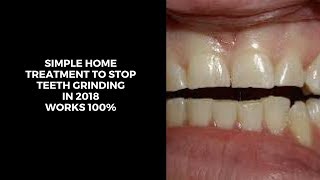 5 ultimate home treatment to stop jaw clenching grinding teeth in sleepbruxism cureteeth grinding [upl. by Aihsot]