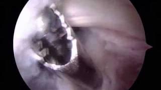 Arthroscopic Removal of Bakers Cyst  ORV  Raymond Whitehead MD [upl. by Joan]