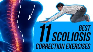 11 Easy Scoliosis Posture Correction Exercises [upl. by Nomzed798]