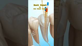 Root Canal in One Canal tooth or 4 Canals [upl. by Sylado264]