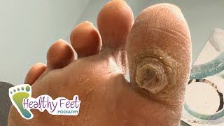 DEEP SATISFYING CALLUS TREATMENT [upl. by Waylin]