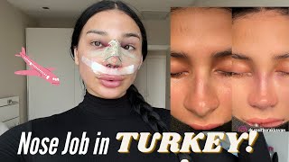 Rhinoplasty inTurkey [upl. by Gambrell]