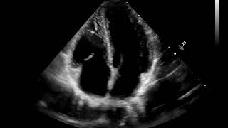 A4C Apical 4 chamber [upl. by Glendon400]