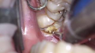 operculectomy of mn 3dr molar [upl. by Gurevich371]