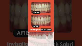 Improve your smile with Invisalign by Dr Ash Sabri [upl. by Supmart]