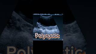 Follicular Ovary  Polycystic Ovaries  PCOS  PCOD  Dominant Follicle on Ultrasound [upl. by Maressa]