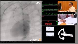 Mentice VIST®C  Catheterisation of the Right Coronary Artery From Right Radial Artery [upl. by Nivrag]