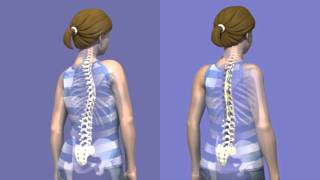 What is Scoliosis surgery [upl. by Goeselt255]