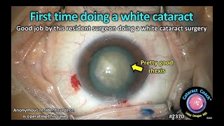 CataractCoach™ 2370 first time doing a white cataract [upl. by Rosemaria]