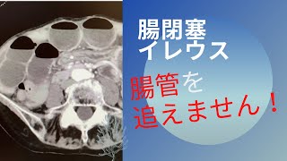 腸閉塞・イレウスのCTで腸管を追跡する練習法 [upl. by Sayer]