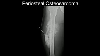 Periosteal Osteosarcoma [upl. by Bartolome]