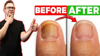 BEST Toenail Fungus Treatment 2024 4 BIG SECRETS [upl. by Rahsab]