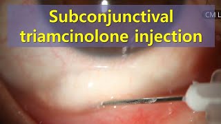 Subconjunctival triamcinolone injection 결막하 트리암시놀론 주사 shorts [upl. by Dub]