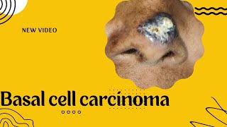 BASAL CELL CARCINOMA  ADENOID VARIANT [upl. by Eudocia4]