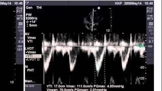 Point of Care Echo Stroke Volume Determination [upl. by Atrebla79]