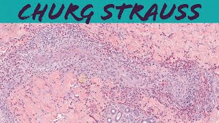 ChurgStrauss syndrome eosinophilic granulomatosis with polyangiitis EGPA vasculitis pathology [upl. by Ahsenal107]