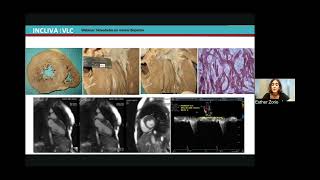 Novedades farmacéuticas y en guías clínicas de la miocardiopatía [upl. by Maccarthy]