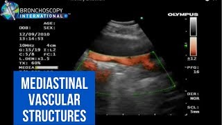 BronchAtlas EBUS and Suspected Pulmonary Embolism [upl. by Maxma]