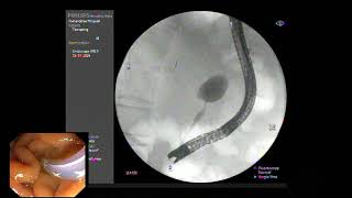 ERCP  EST with SEMS placement for mid CBD stricture from advance pancreatic cancer [upl. by Carena]