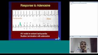 Tachyarrhythmias in Children by Dr Suresh Kumar [upl. by Tamis]