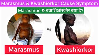 Marasmus and ￼￼ Kwashiorkor Cause Symptom Treatment  Marasmus  Kwashiorkor  Marasmus Kwashiorkor [upl. by Mikeb]