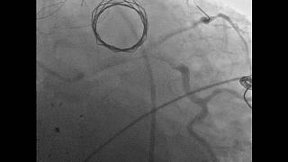 Vol3 Issue 4  Video 5 Continuous Assessment of a Stented Coronary Artery [upl. by Bashee]