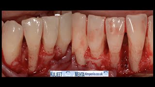 Periodontal Surgery with PRF [upl. by Arotahs]